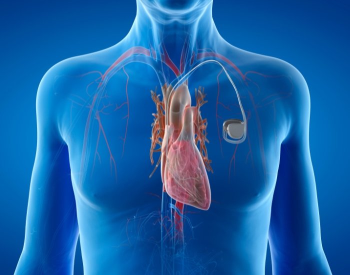What Is The Role Of A Pacemaker For AFib?