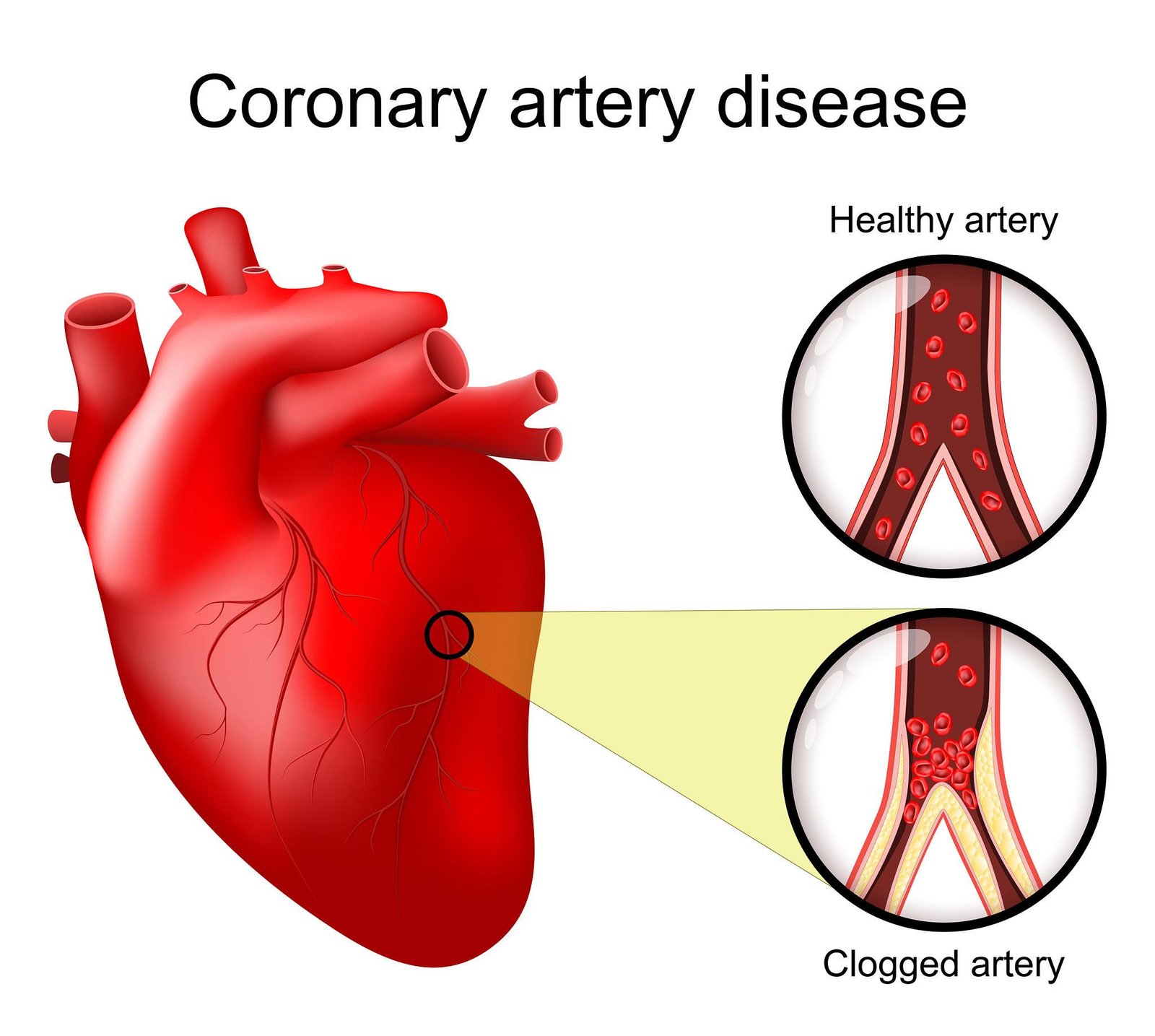 Illustration showing clogged arteries to the heart and reduced blood flow causing heart blockage symptoms