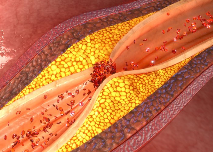 Coronary Artery Disease